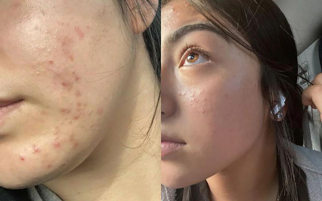 Vì sao mụn "ghé thăm" ở tuổi dậy thì? (Hiểu đúng về nguyên nhân để trị mụn hiệu quả hơn)