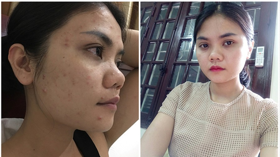 Câu chuyện và Kinh nghiệm Thực tế trị mụn tuổi teen bằng kem trị mụn