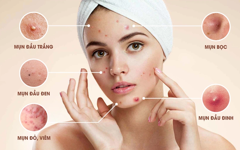 Tại sao tuổi teen thường bị mụn và vai trò của sản phẩm trị mụn?