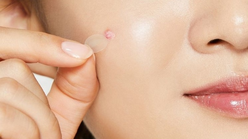 "Điểm danh" các loại sản phẩm trị mụn phổ biến cho tuổi teen