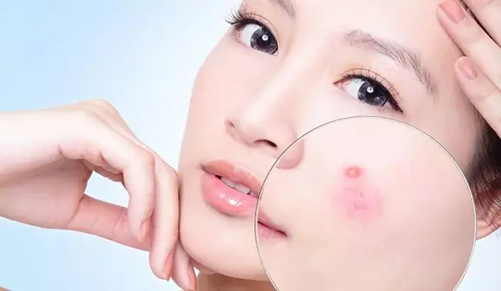 Câu chuyện và kinh nghiệm thực tế về trị mụn tuổi teen