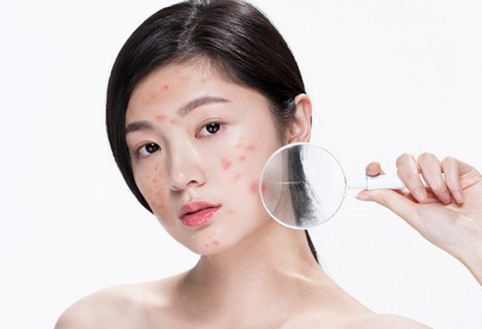 Giải quyết các vấn đề da phổ biến ở tuổi dậy thì