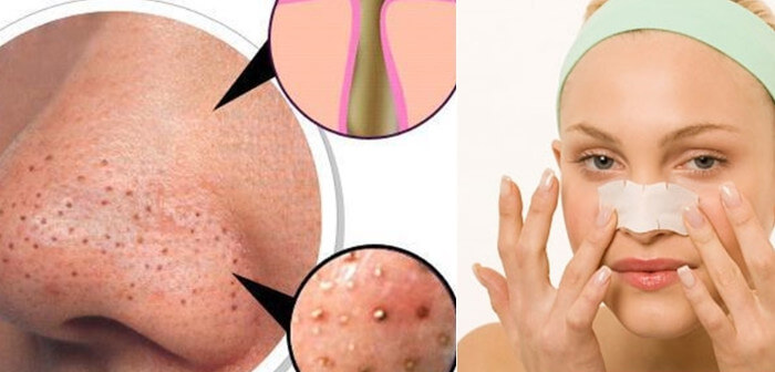 Mụn đầu đen là gì và tại sao tuổi teen dễ bị mụn đầu đen?