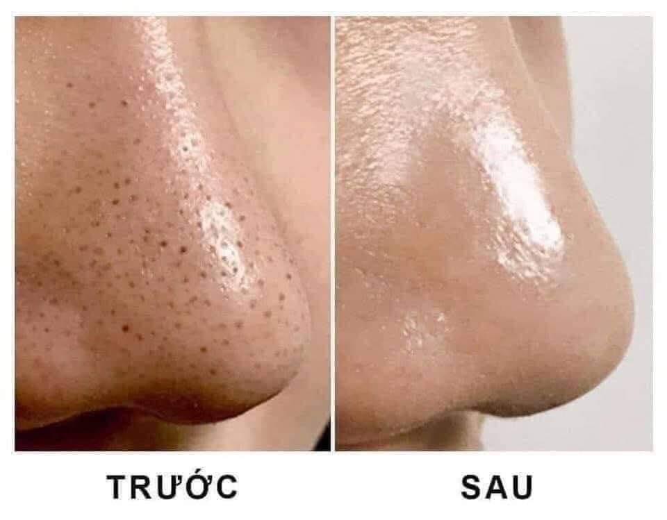 Ngăn ngừa mụn đầu đen tái phát – Chìa khóa cho làn da láng mịn
