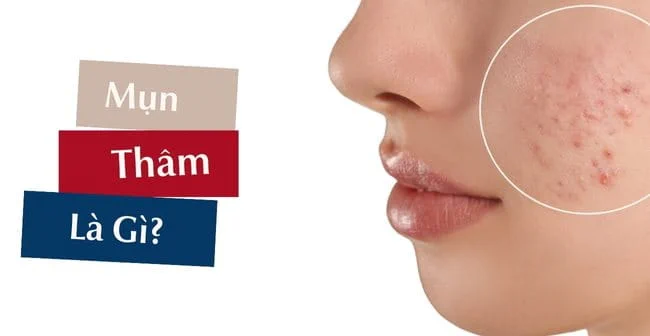 Thâm mụn là gì? Tại sao da học sinh dễ bị thâm mụn sau khi hết mụn?