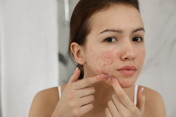 Khi nào thâm mụn cần đến sự can thiệp của chuyên gia?